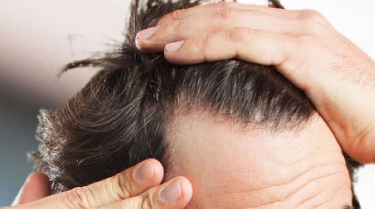 Stres erkeklerde saçları döküyor