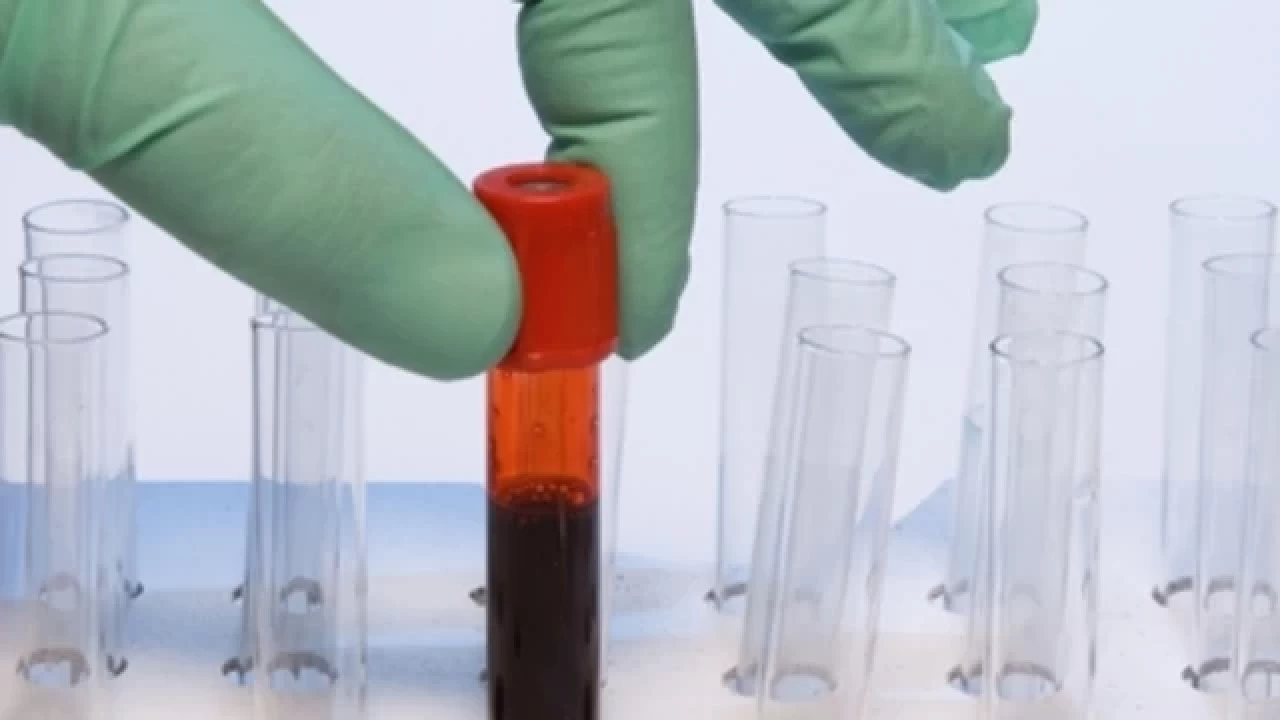 Kan Tahlilinden Önce Yemek Yenir Mi? Kan Tahlili Öncesi Dikkat Edilmesi Gerekenler