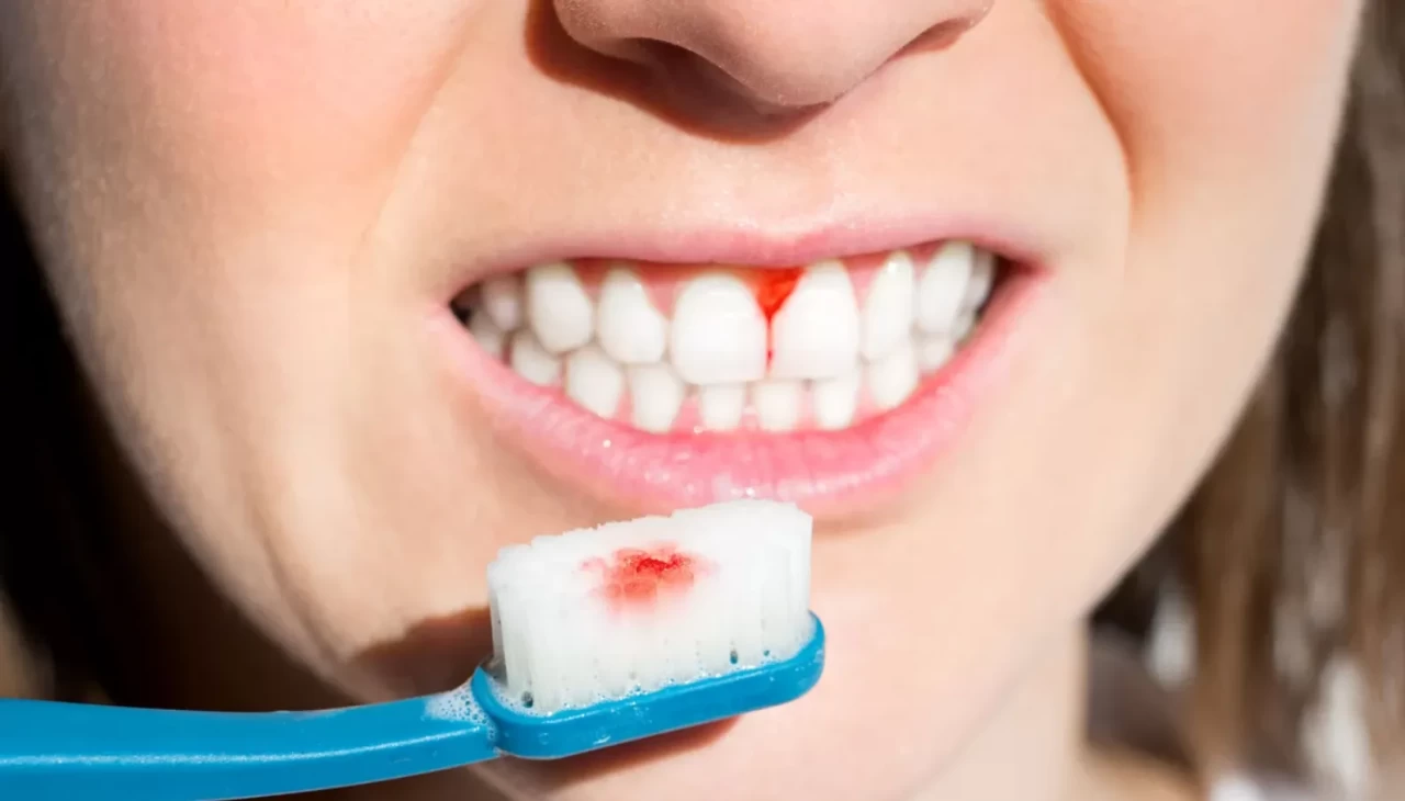 Diş eti kanaması nasıl geçer? Evde doğal yöntemlerle 3 günde son!