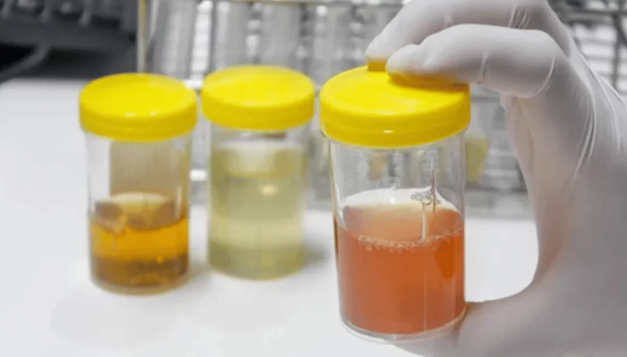 İdrar rengi ne anlama gelir? Hangi renk hangi hastalığın habercisi?