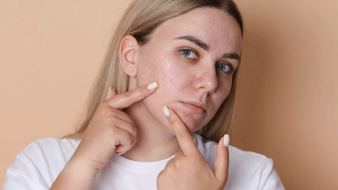 İlaçsız Sivilce İzi Silme Rehberi! Doğanın Gücüyle Pürüzsüz Cilt Etkisi