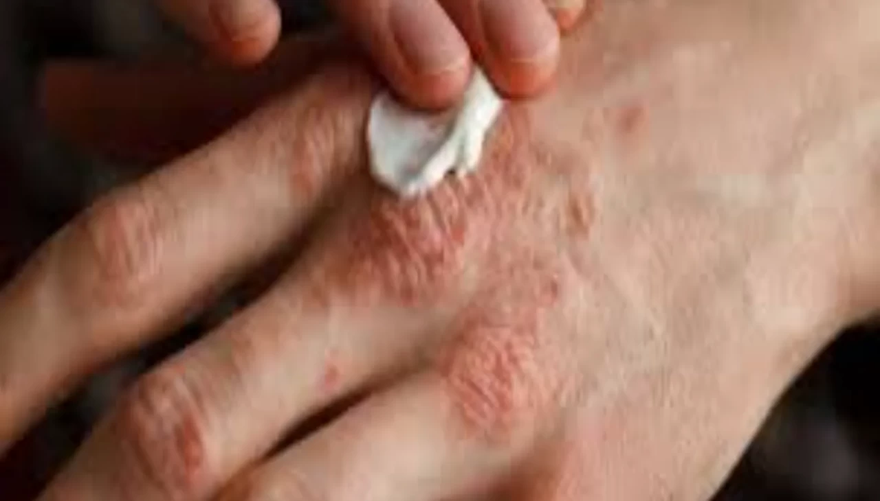 Saraçoğlu’ndan doğal Egzama reçetesi! Beyaz dut ve defne yaprağıyla ciltte rahatlama