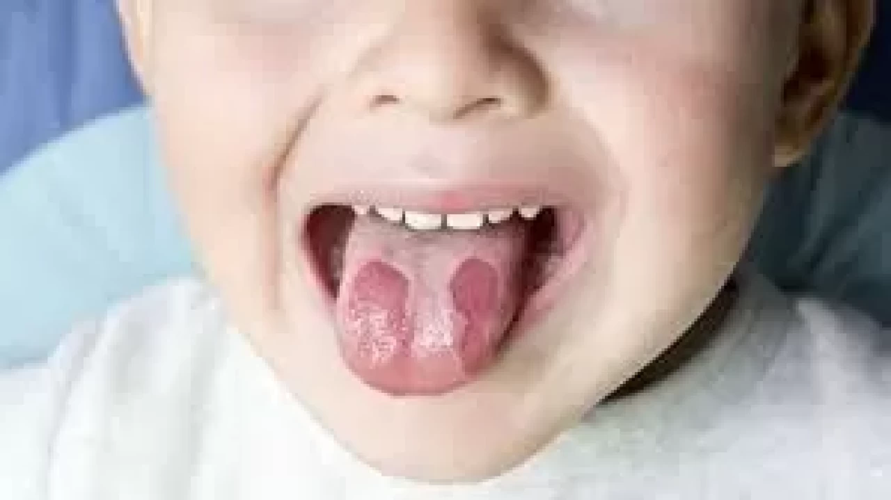 Bebeklerde Coğrafik Dil Sorunu: Belirtileri ve Çözüm Yolları