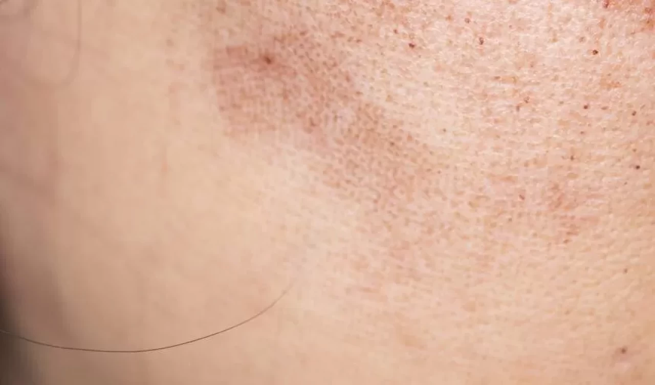 Cilt tonunuzu 1 haftada eşitleyin! Sadece 7 günde cilt lekelerini yok ediyor