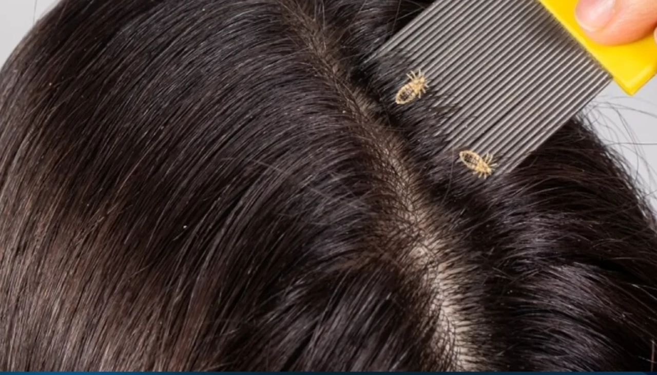 Saçınızda aniden bit belirdiyse dikkat! Sebebi bakın neymiş