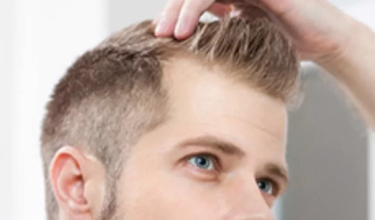 Saç ekimi sonrası nelere dikkat edilmeli?