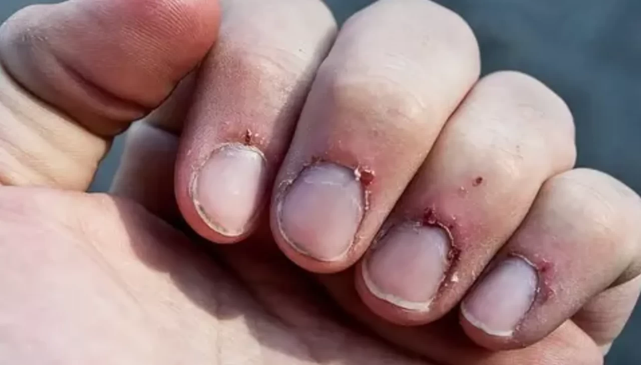 Tırnak eti neden soyulur? İşte en önemli 5 sebebi