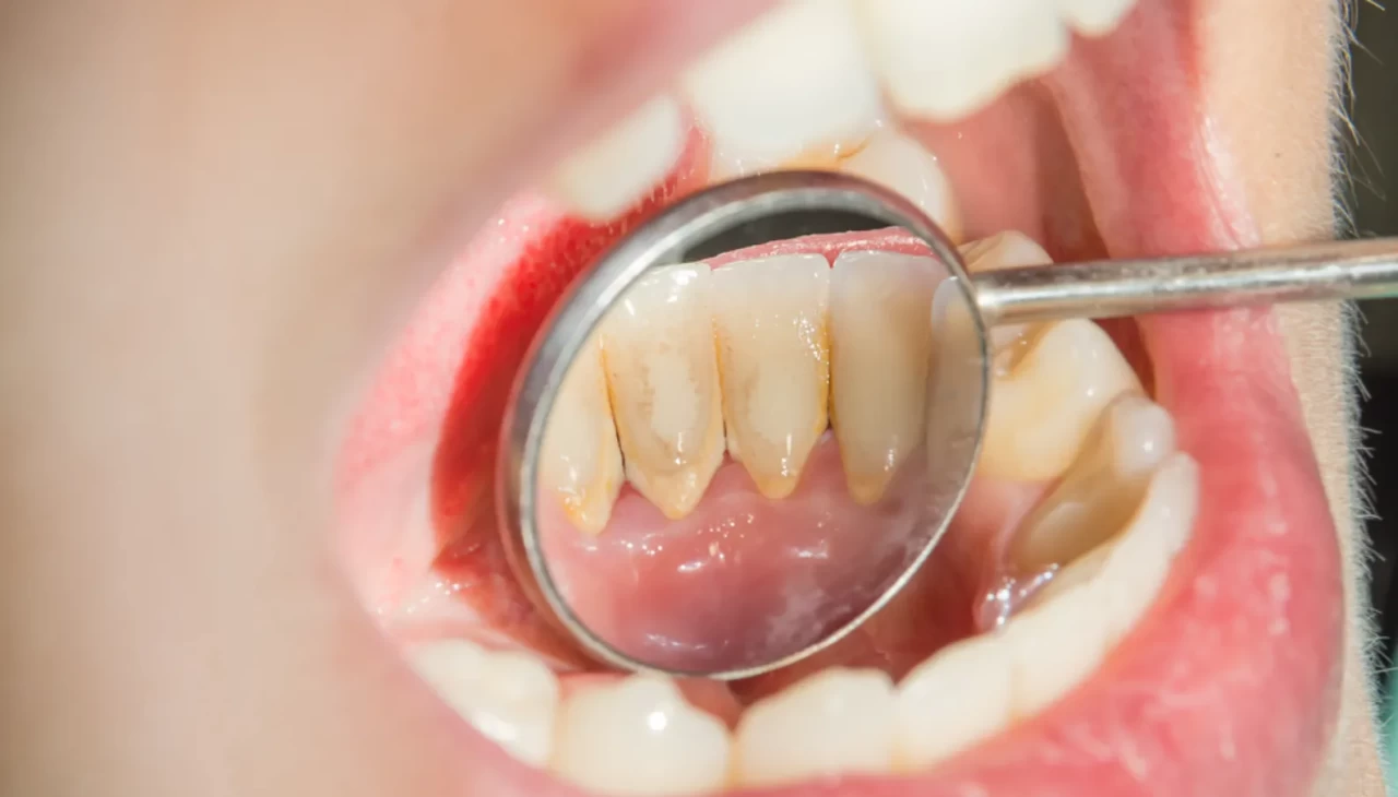 Gören inanamadı! Küçücük diş eti taşları ölümcül riski ortaya çıkarıyor