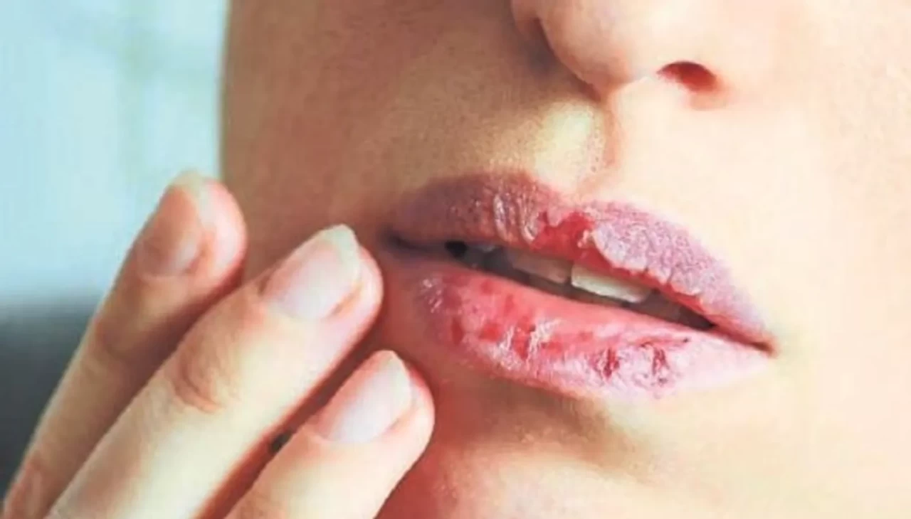 Çatlayan dudaklara 1 gecede etki eden doğal formül