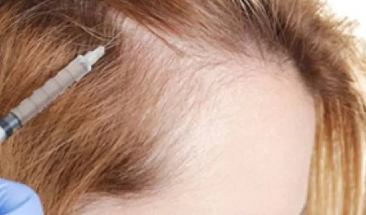 PRP saç tedavisi nedir ve nasıl uygulanır?