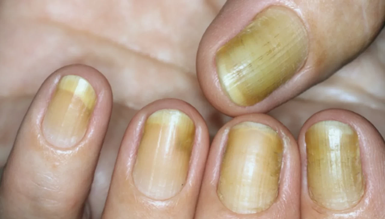 Sarı tırnak sendromu nedir? Tırnak sararmasının nedenleri ve belirtileri hakkında bilmeniz gerekenler