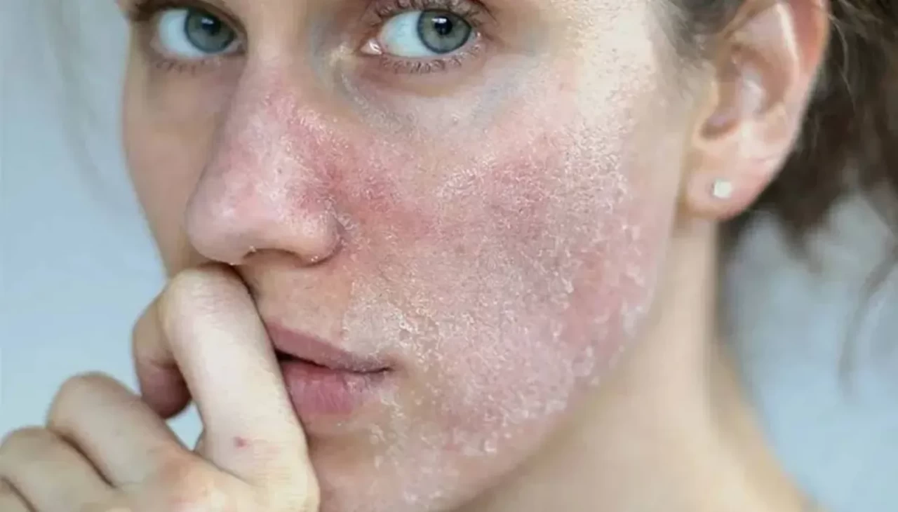 Cilt kuruluğuna ve pullanmaya son! Kışın yüzünüzü böyle yıkayın