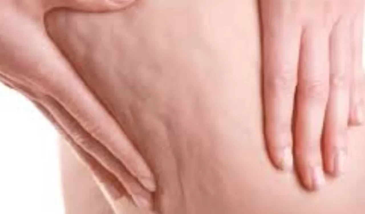 Doğum kontrol hapları selülit yapar mı?