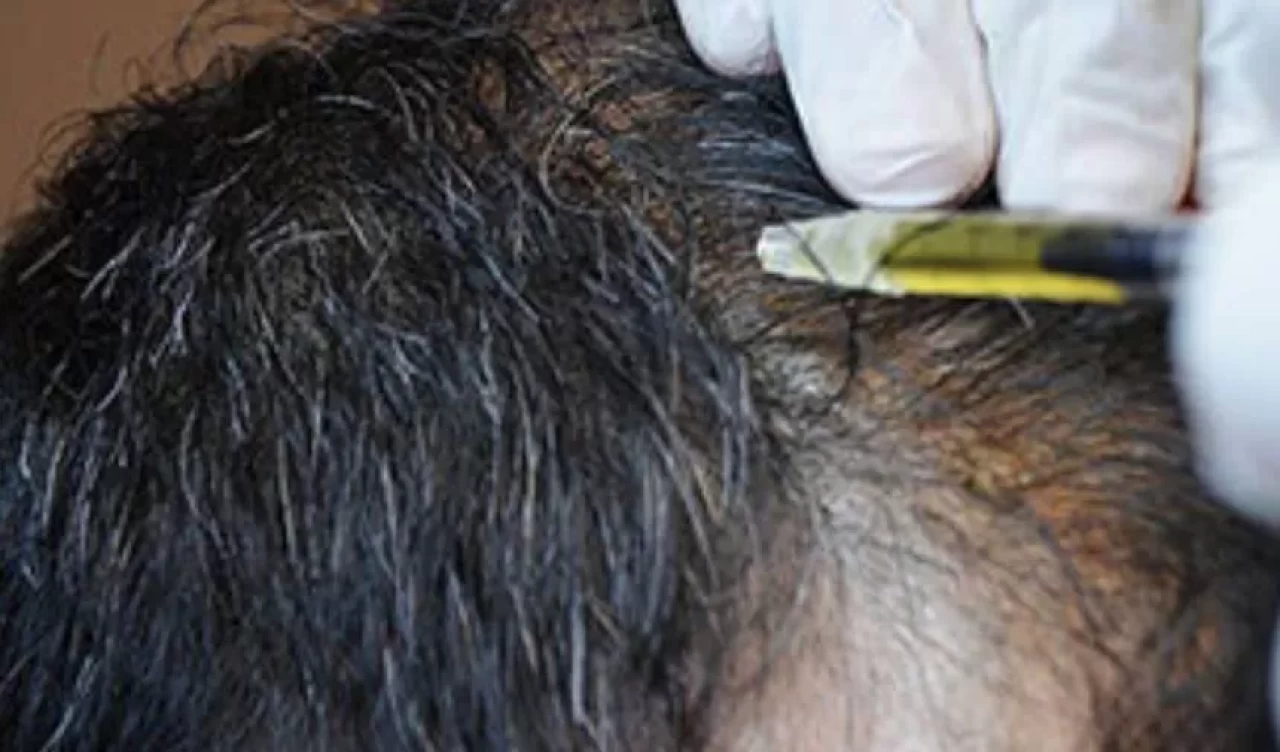 Kendi saç köklerinden saç ekimi nedir ve nasıl yapılır?