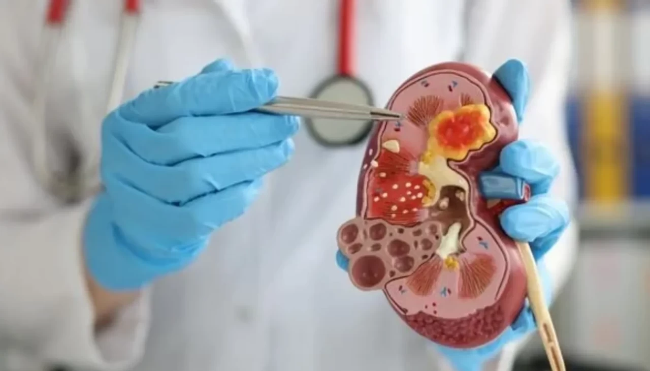 Ağrısız Taş Düşürme Mümkün mü? İşte Evde Uygulanabilecek Doğal Reçeteler