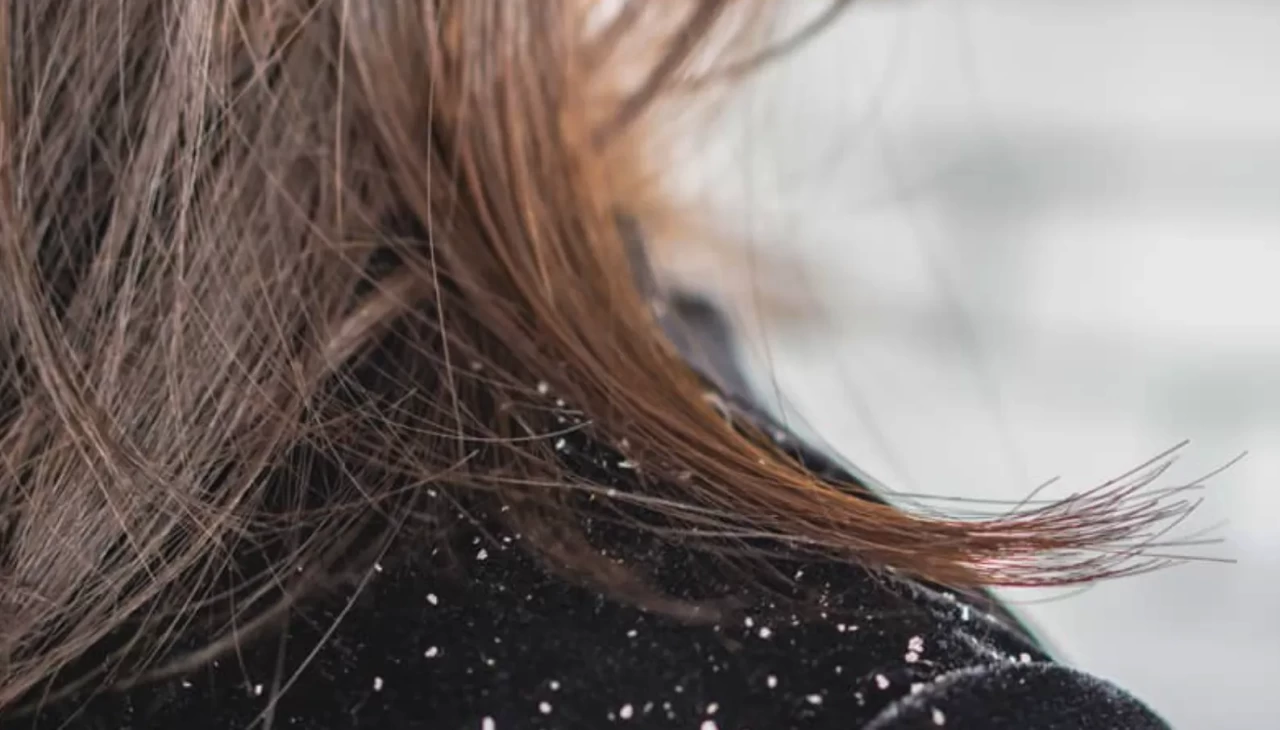 Kepek neden gitmiyor? Farkında olmadan her gün tekrarladığınız 7 hata!