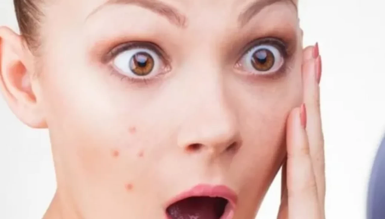 Sivilce patlamasının nedeni meğer bu takviyelermiş! Uzmanlar 6 tehlikeyi açıkladı