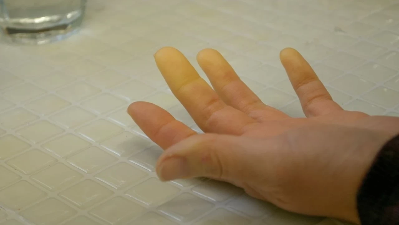 Kışın Kadınlarda Soğuk Çarpması ve Serçe Parmak Üşümesi: Belirtileri ve Tedavi Yöntemleri