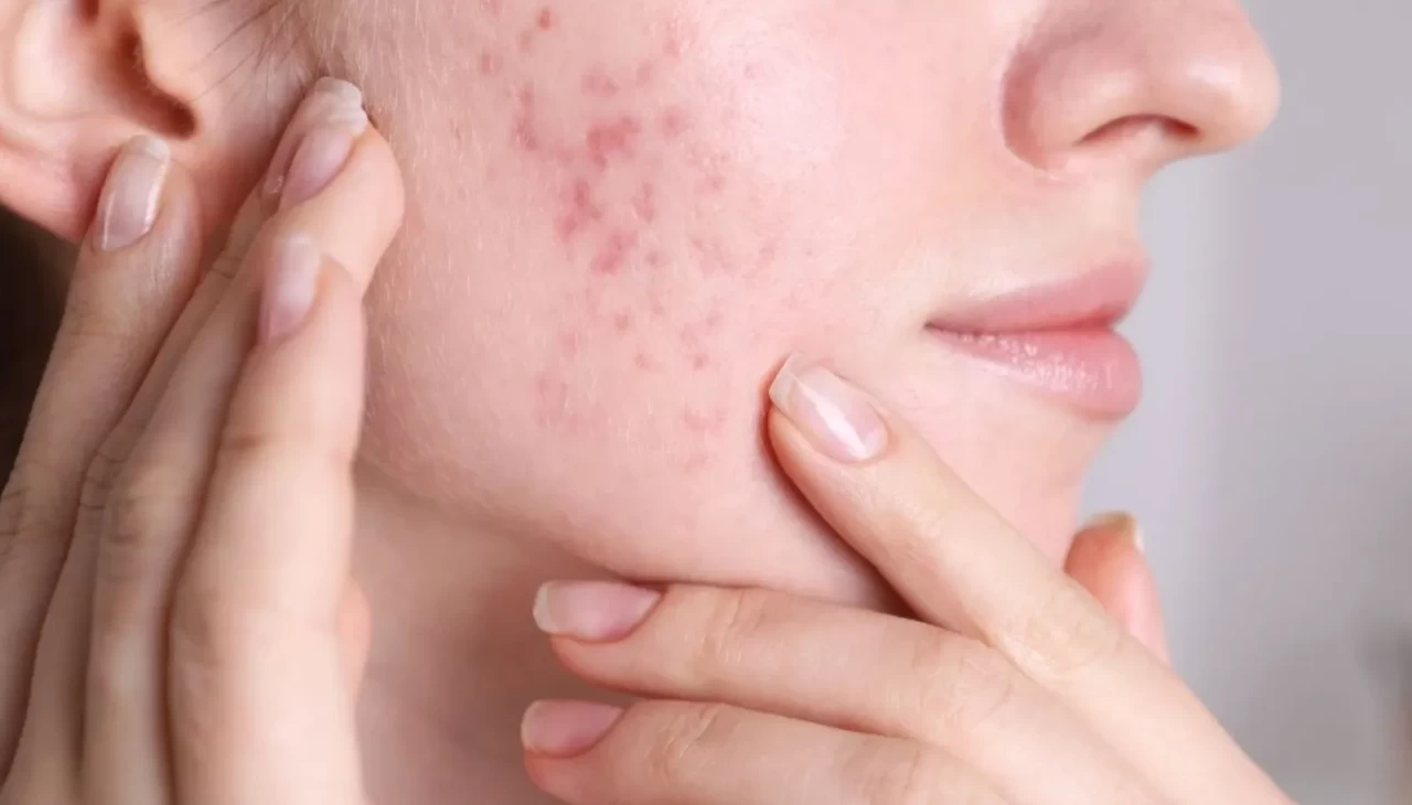 Kırmızı sivilce lekelerine büyük darbe! Evde yapılan bitkisel serumla ışıldayan cilt