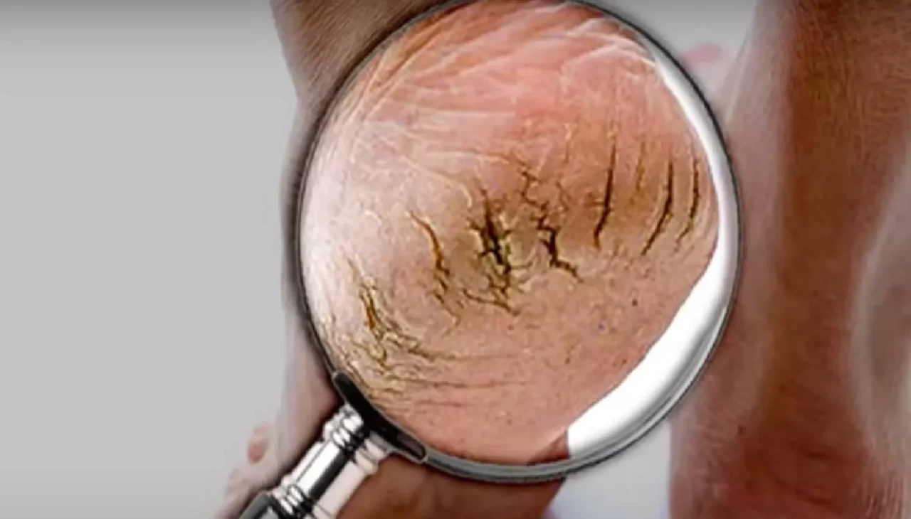 Kuruluk sanıyorduk! Meğer topuk çatlakları bakın hangi hastalıkların habercisiymiş