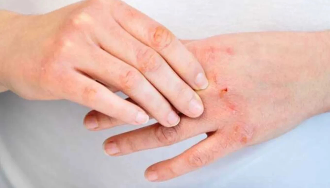 Egzama neden artıyor? Uzmanlar bakın neye işaret ediyor!