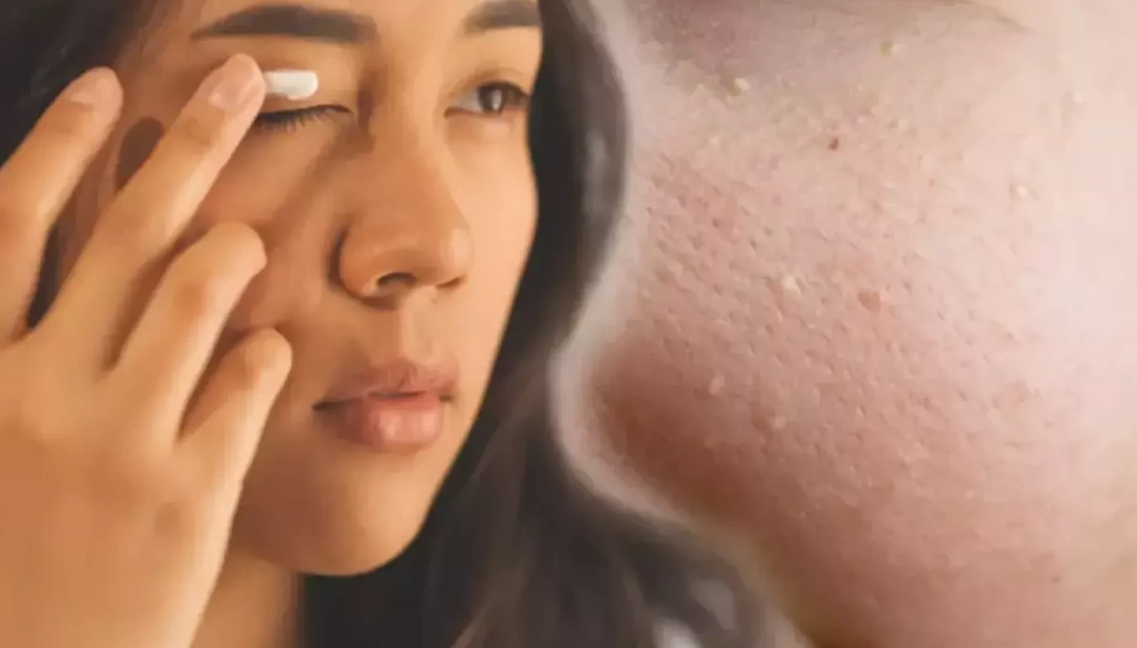 Göz çevresindeki miliaları yok eden ev yöntemi! Binler paylaşıyor, etkisi şaşırtıyor