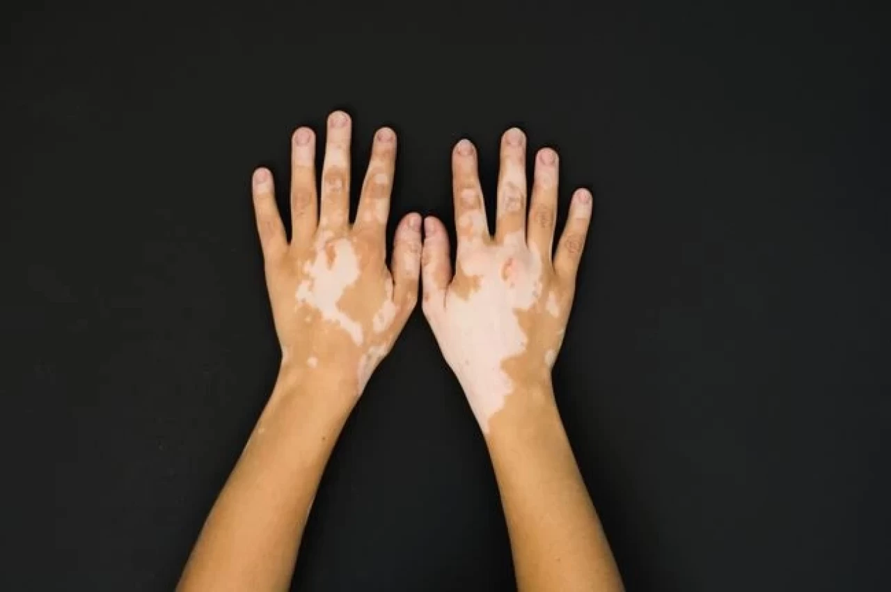 Vitiligo Nedir? Ciltte Beyaz Lekeler Neden Oluşur?