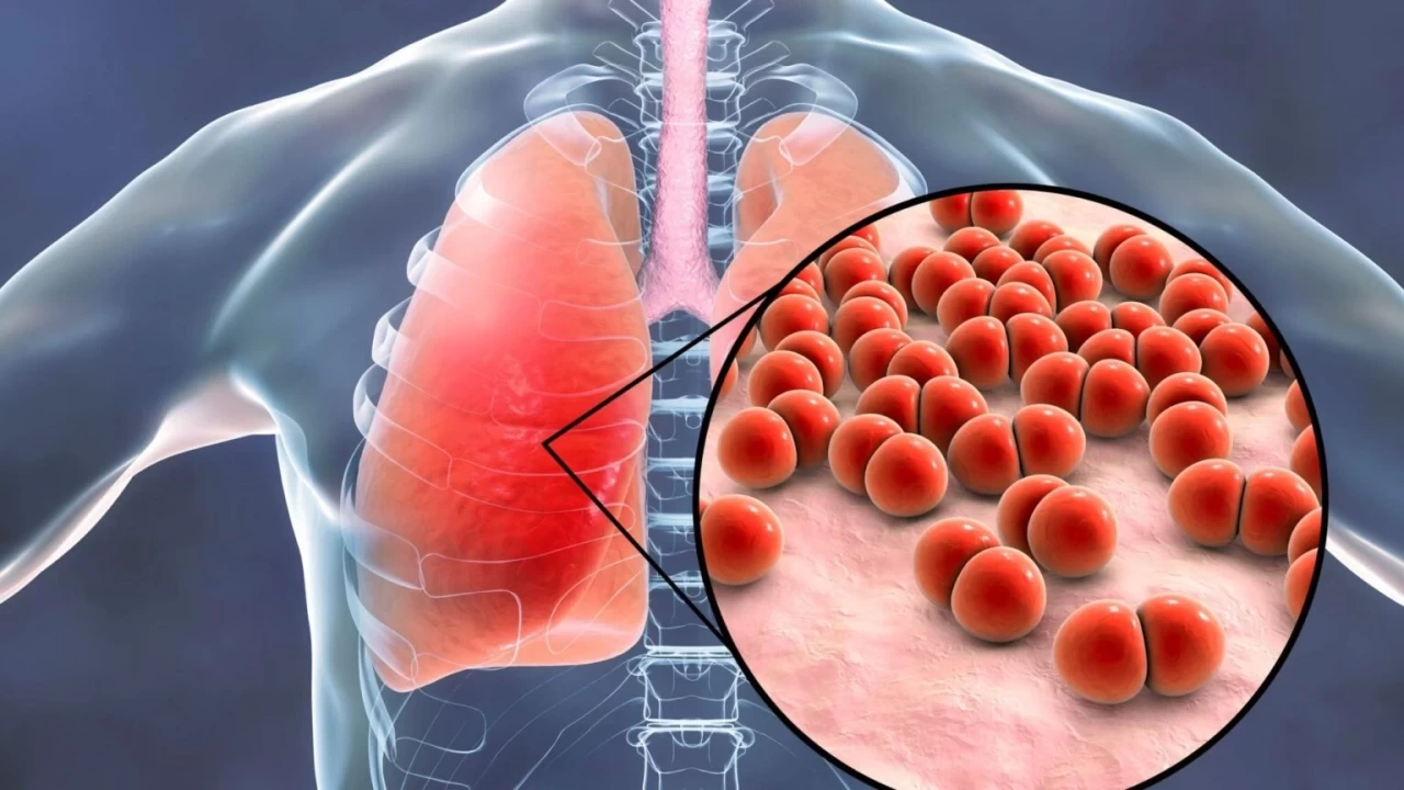 Üşüterek Zatürre olunur mu, kaç günde geçer?