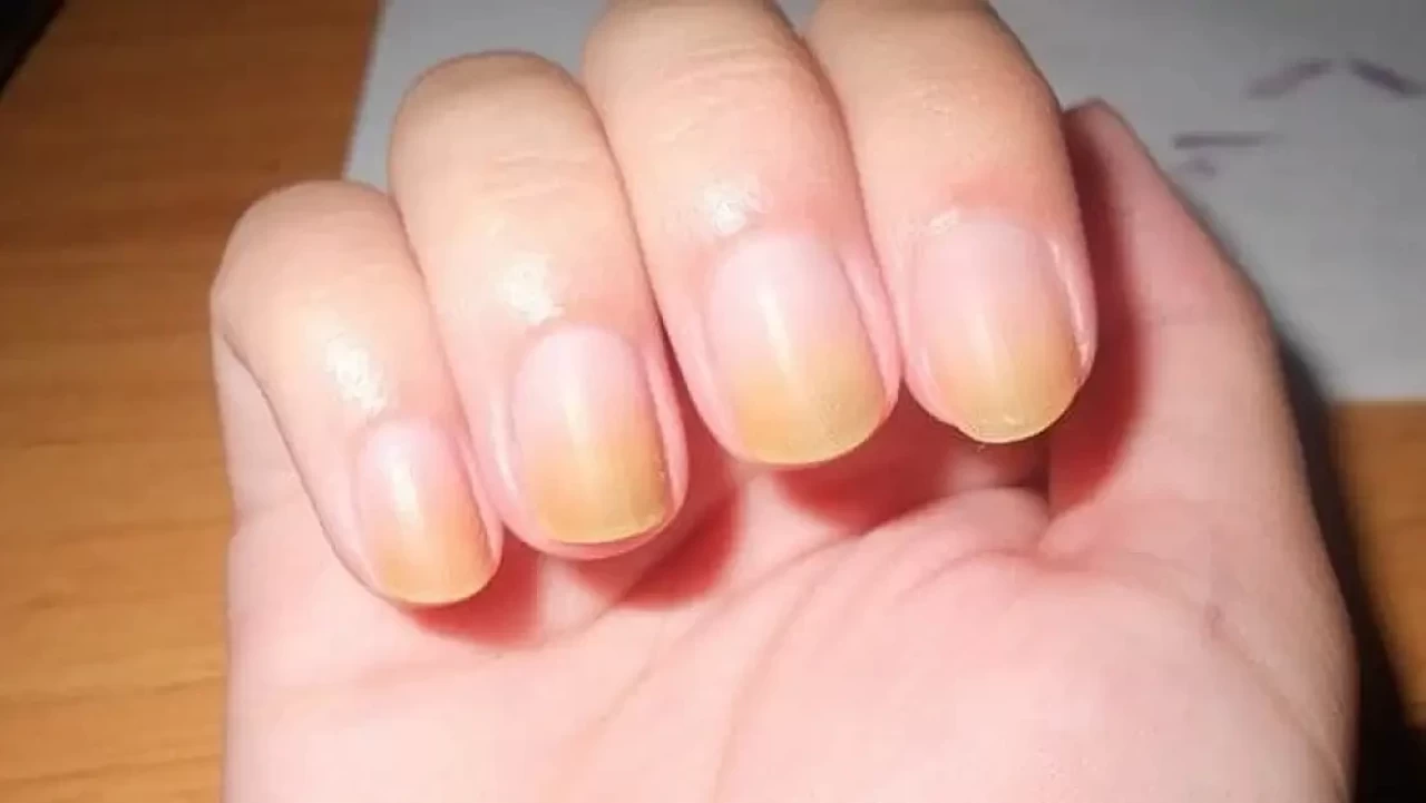 Tırnaklarınız sararıyor mu? İşte cevabı...