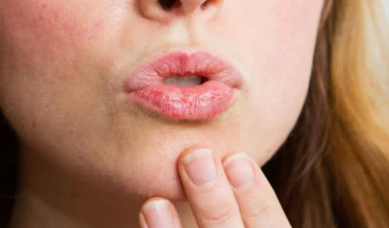 Kış aylarında dudak kuruması nasıl önlenir? İşte etkili çözümler!