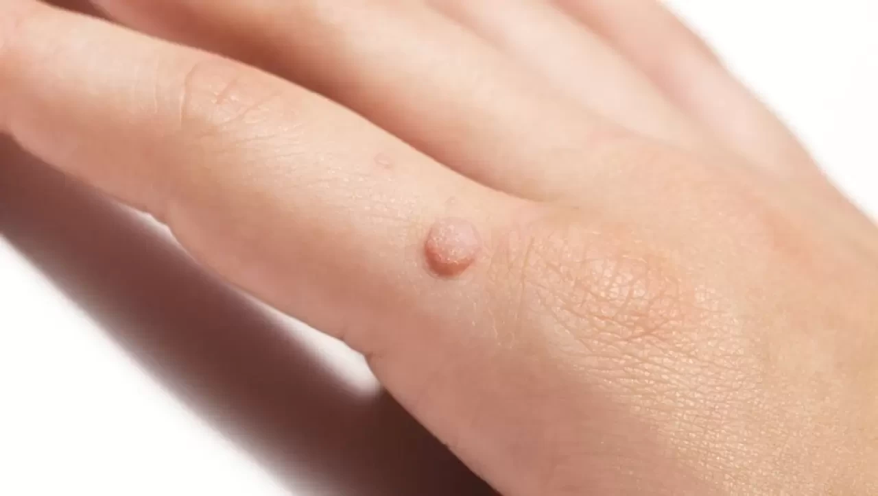 Siğil Nedir ve Neden Oluşur? Tedavi Yöntemleri Nelerdir?