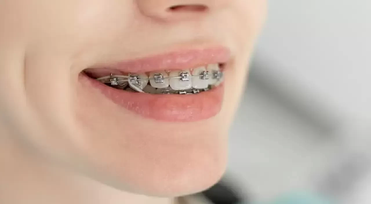 Diş Teli Varken Dondurma Yenir Mi? Diş Sağlığına Zararı Var Mı?