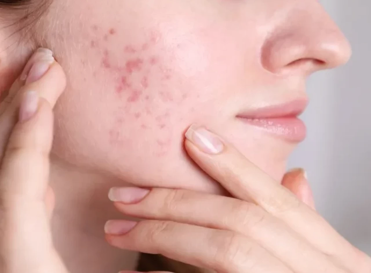 TikTok’ta virüs gibi yayınlan sivilceye sarımsak sürme akımı tehlike mi saçıyor?