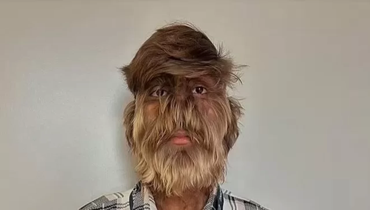 Vücudunda her santimde 202 kıl var! Dünya rekorunu kırdı