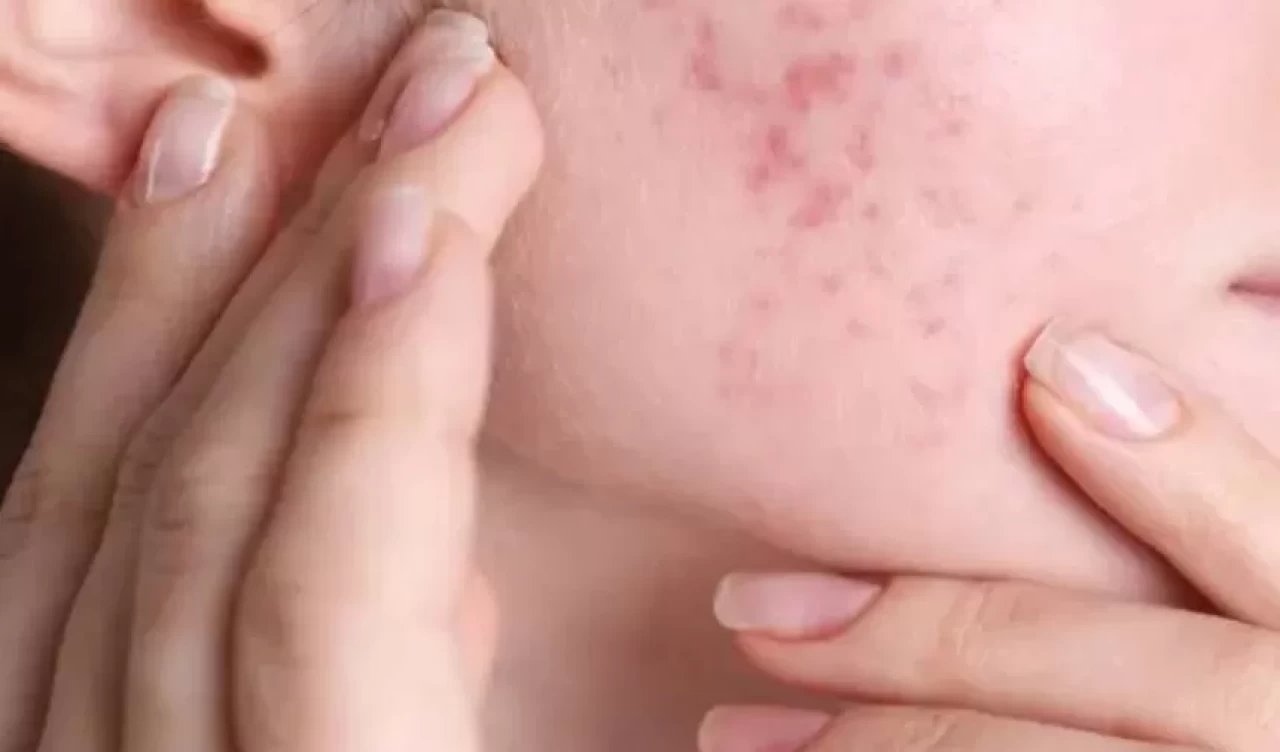 Yağlı ciltler için çay ağacı yağı: Sivilceleri azaltan doğal iksir