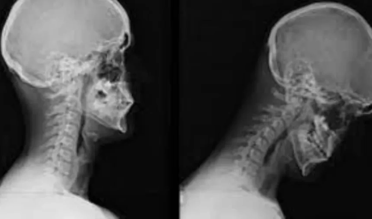 Cep boyun sendromu (Text Neck) nedir? Belirtileri, risk grupları ve çözüm yöntemleri