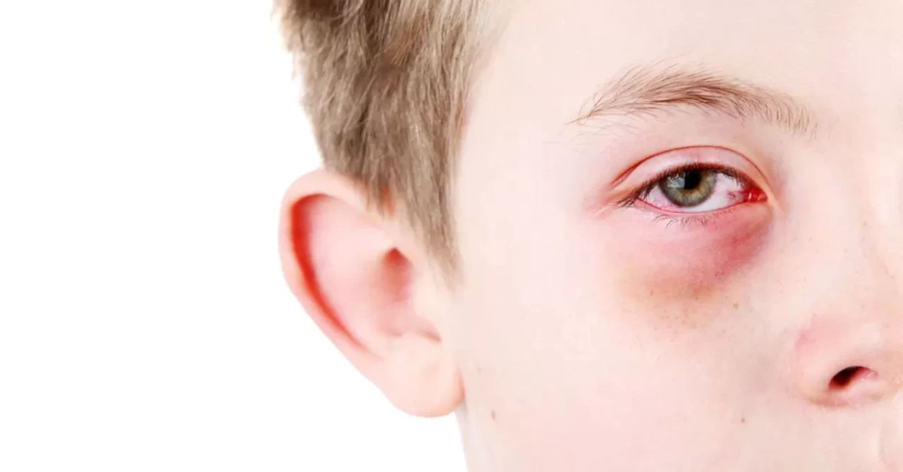 Baharın gelmesiyle birlikte göz alerjisi riski artıyor! Peki, bu rahatsızlıktan korunmak için neler yapılabilir?