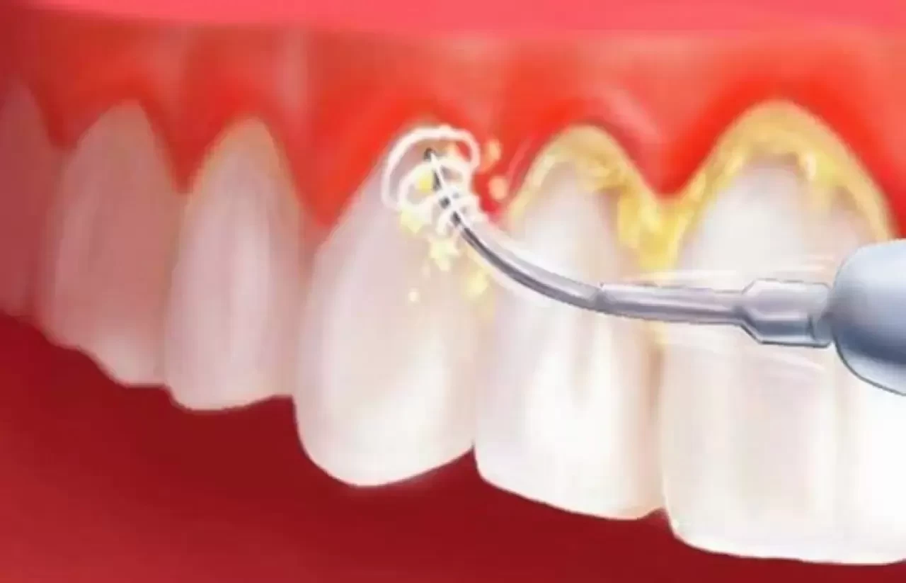 Evde Diş Taşı Temizliği: Doğal Yöntemlerle Sağlıklı ve Beyaz Dişlere Kavuşun