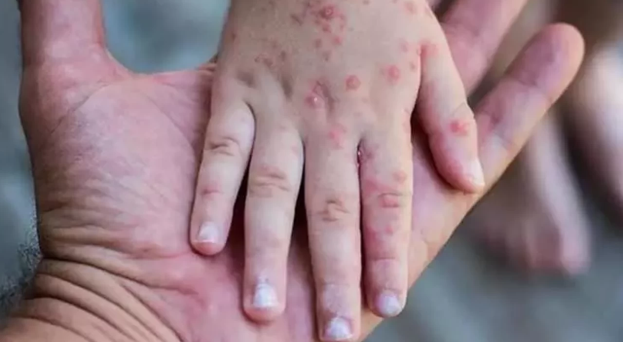 Liberya, M çiçeği virüsü için 10 bin doz aşı aldı