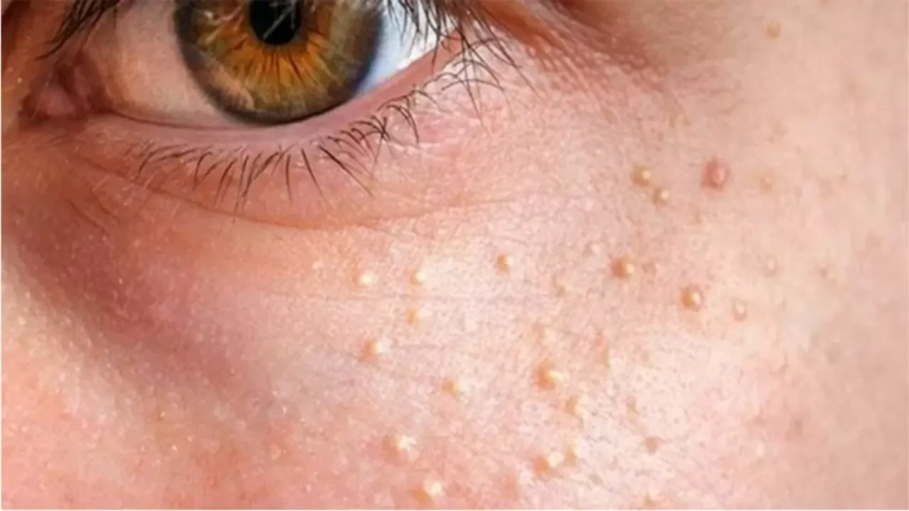 Yağ Bezesine Ne Sebep Olur ve Nasıl Tedavi Edilir?