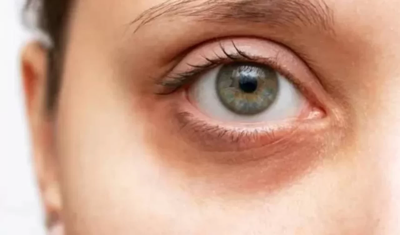 Hangi kremler göz altı morluklarını azaltır?