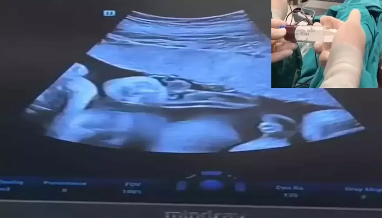 Batman'da anne karnındaki 8 aylık bebeğe kan nakli yapıldı