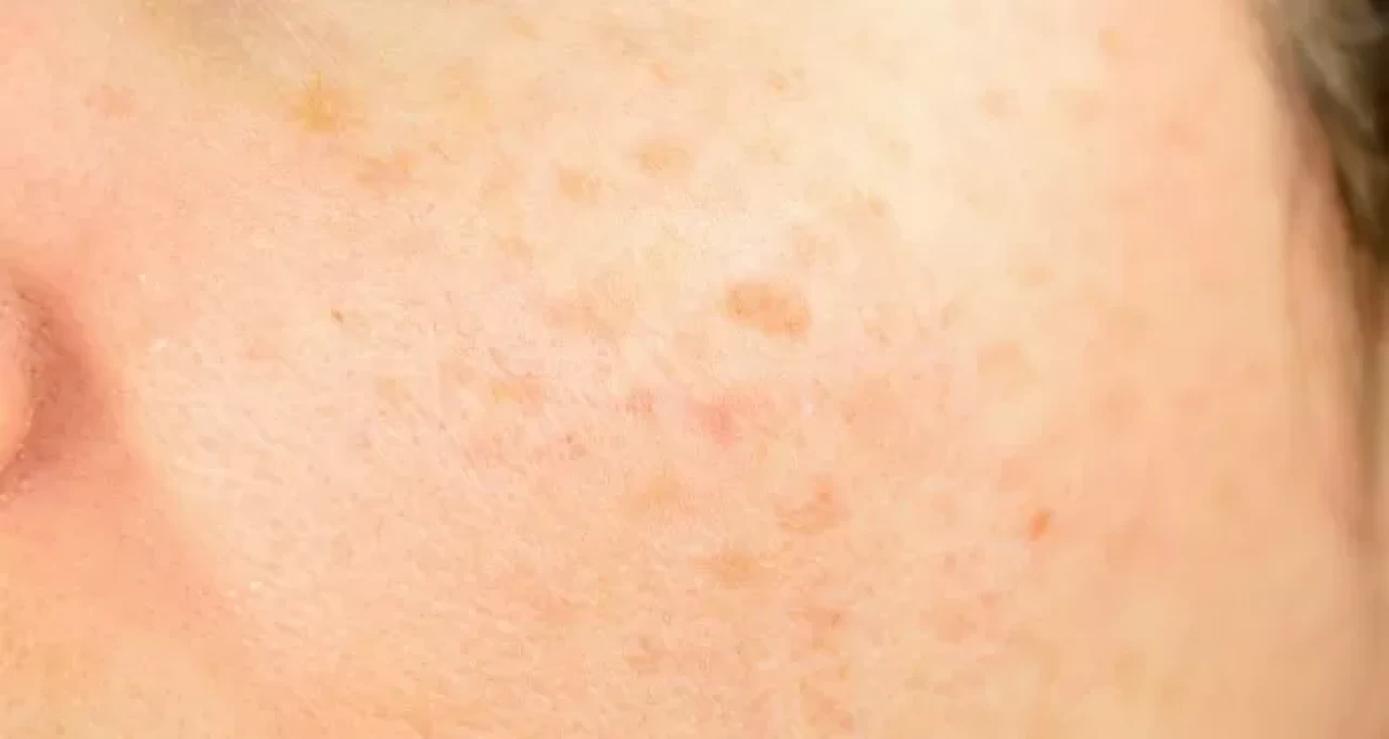 Limon cilt lekelerine iyi gelir mi?