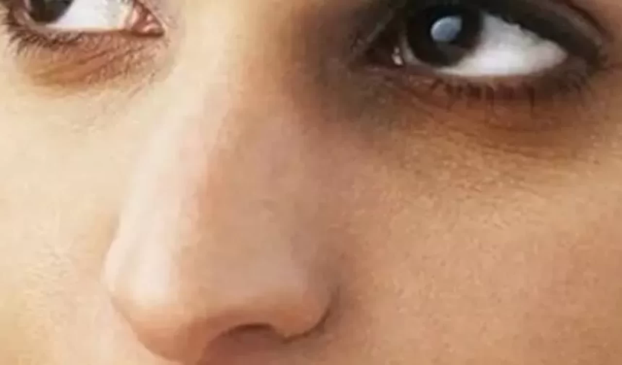 Göz altı morluklarına ne iyi gelir?