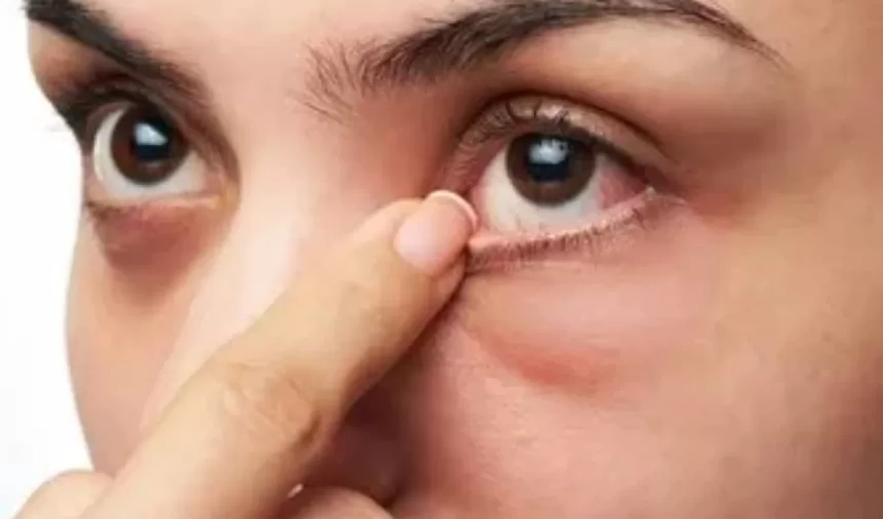 Göz altı torbalarına ne iyi gelir? Göz altı torbalarından kurtulmanın yolları