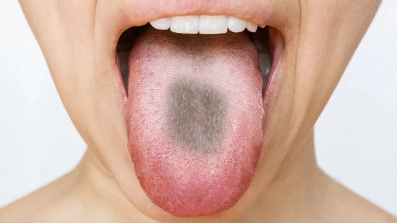 Siyah tüylü dil neden olur?