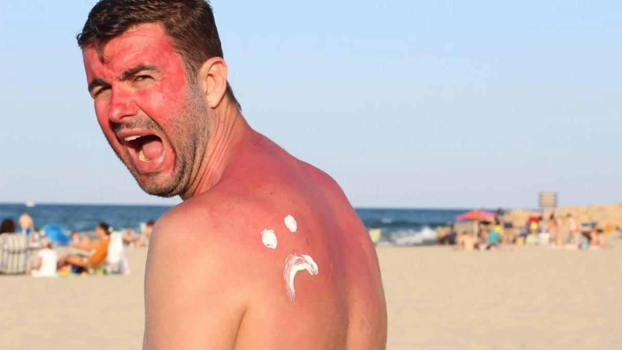 Bu yaz başka yaz! Güneş yanığı olmayın