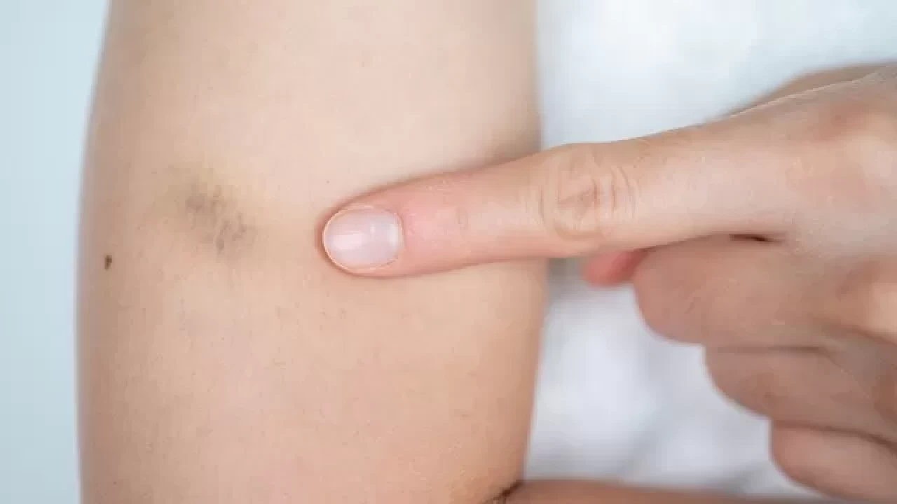 Durduk yere oluşan morluklar lipödem belirtisi mi?