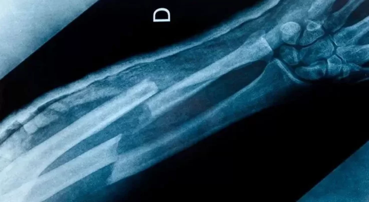 “Kemiği kırılmayanlar” teorileri gündemde! Bilim: İddiaların gerçeklik payı yok