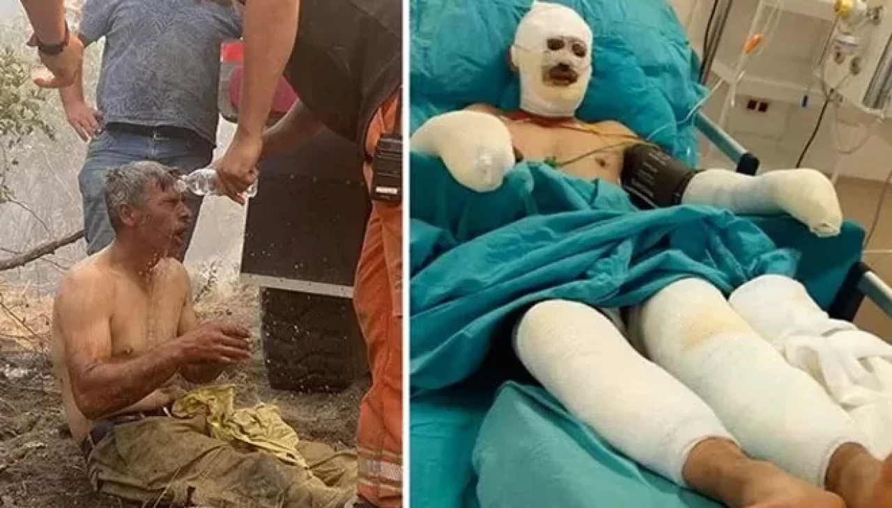 "Yanıyorum" diye feryat etmişti! Orman işçisinin tedavisi sürüyor